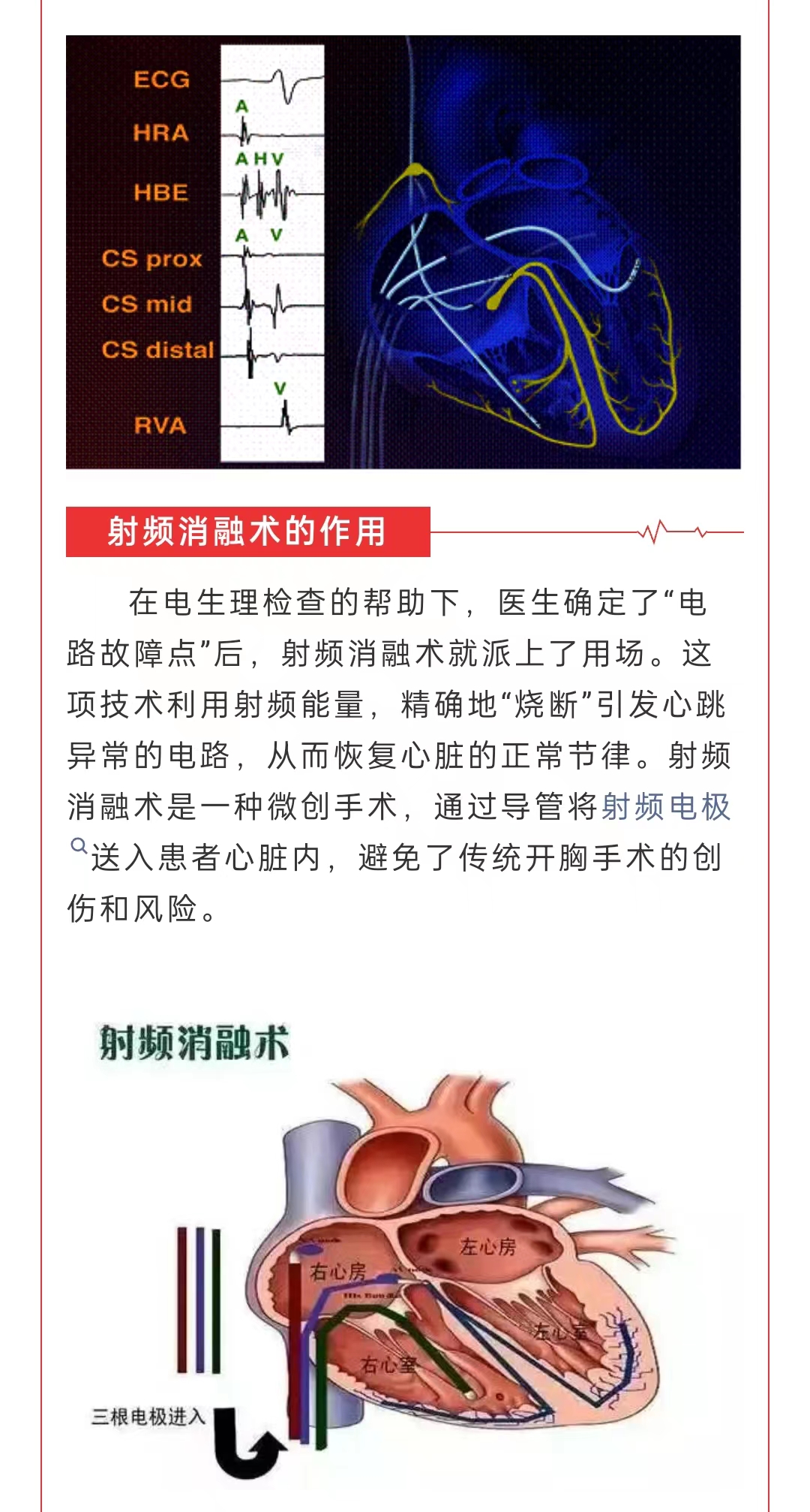 射频消融技术前沿，科技重塑生活体验最新技术成果